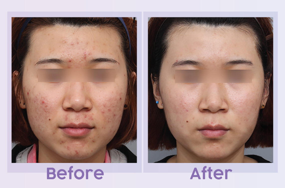 PRP before and after result 2